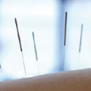 Acupuncture